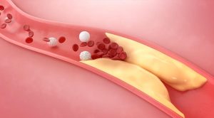 Genetic Cholesterol Eliminated By New Drugs