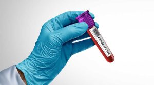 New Test Tracks Alzheimer’s Protein Clumps in Blood