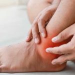 Cankles—Causes-Treatment