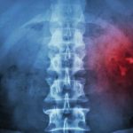 Kidney Stones! kidney-stones