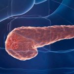 Pancreatic-Cancer