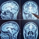 Healthier Brain Scans With This Common Vitamin healthier-brain-scans